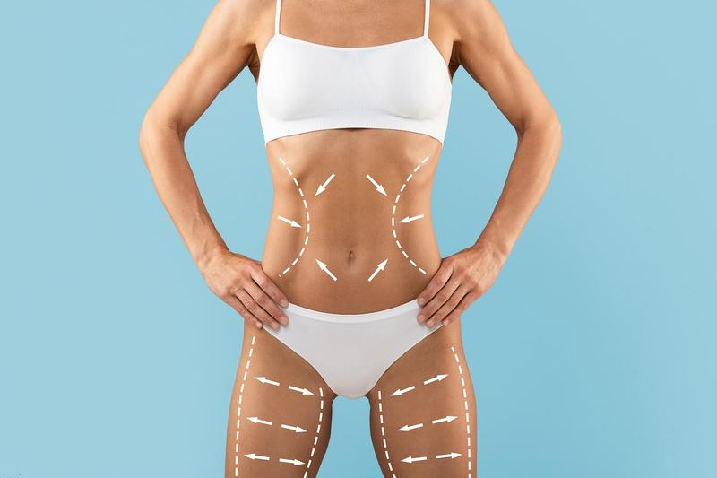 Avan&ccedil;os tecnol&oacute;gicos ampliam resultados da lipoaspira&ccedil;&atilde;o