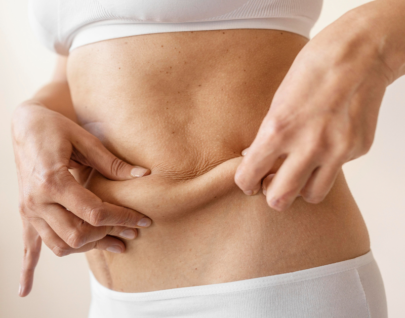 Tecnologia melhora retra&ccedil;&atilde;o da pele ap&oacute;s lipoaspira&ccedil;&atilde;o