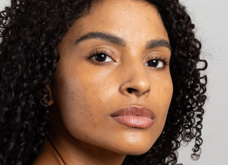 M&ecirc;s de Conscientiza&ccedil;&atilde;o da Acne incentiva cuidados especiais