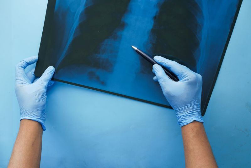 CONITEC abre consulta para Hipertens&atilde;o Arterial Pulmonar